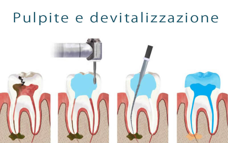 Terapia canalare