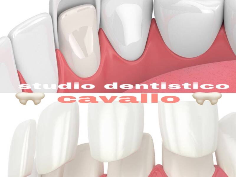 LE FACCETTE DENTALI